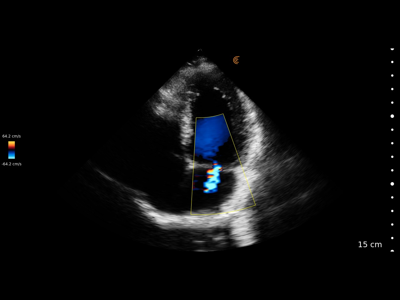 Clarius - Estudio cardíaco con modo color Doppler
